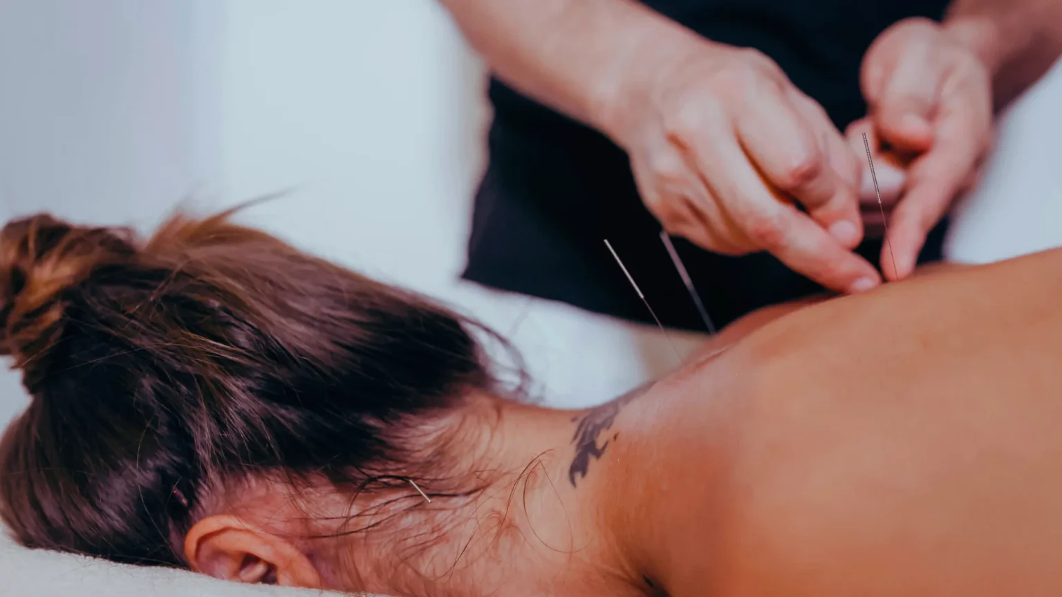 dry needling (1)